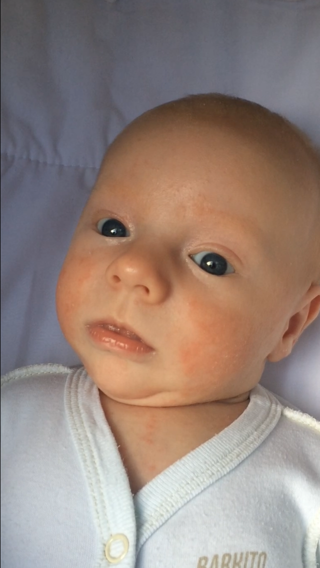 Носогубный треугольник у младенца. Синий носогубный треугольник. Цианоз носогубного треугольника у ребенка. Цианоз носогубного треугольника у новорожденного.