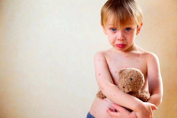Вирус герпеса шестого типа чаще всего развивается у детей раннего возраста и сопровождается высокой температурой, интенсивной сыпью