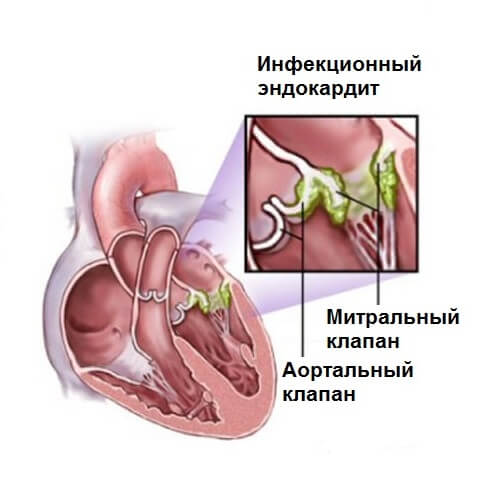 Endocarditis-2