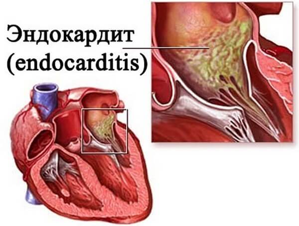 Endocarditis-5