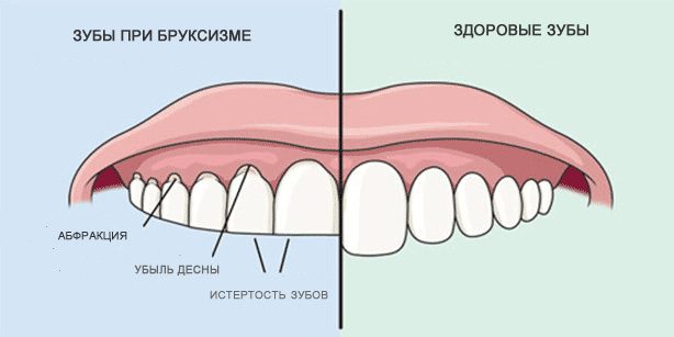 Скрипеть зубами: Здоровые зубы и зубы при бруксизме