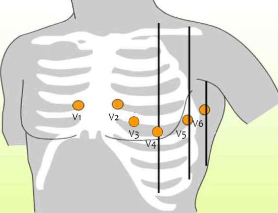 Точки прикрепления электродов к грудной клетке