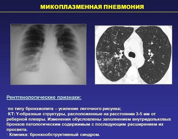 Рентгенологические признаки