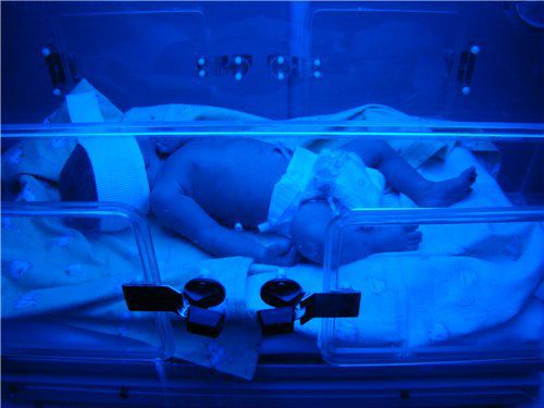 Лечение желтухи УФ-лампой у новорожденного