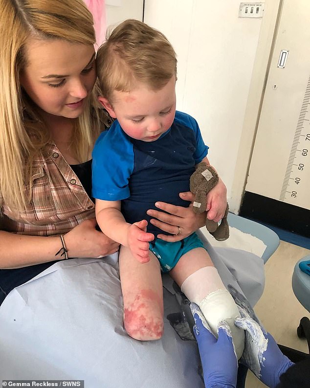 The little fighter underwent multiple amputations losing both of his lower legs and parts of nine fingers. He is pictured here with mum, Gemma, 30, having his prosthetic legs fitted