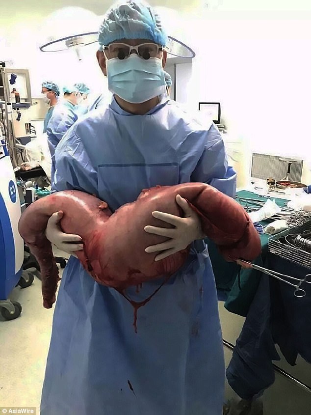 Chinese doctors removed 28 pounds of feces from the bowels of a 22-year-old man who was reportedly constipated since birth (pictured) 