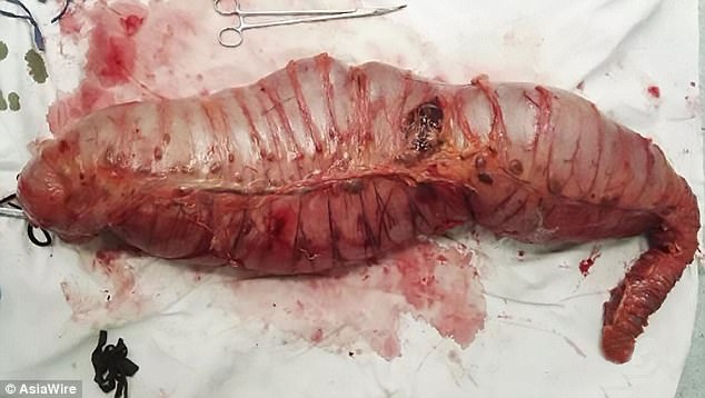 The surgeons at Tenth People’s Hospital of Shanghai in China removed 30 inches of the affected part of his colon (pictured) 