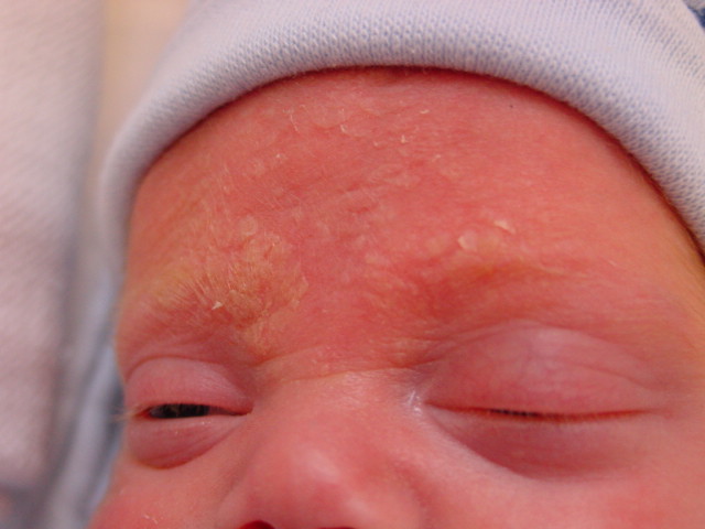Новорожденный с корочками на бровях в возрасте 14 дней