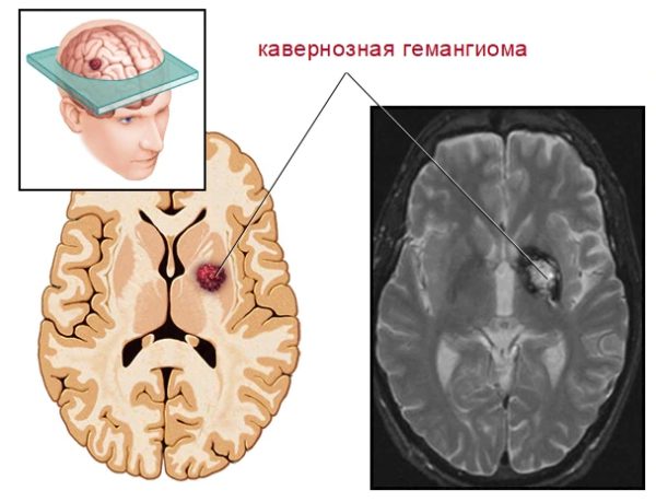 Кавернозная гемангиома в мозге