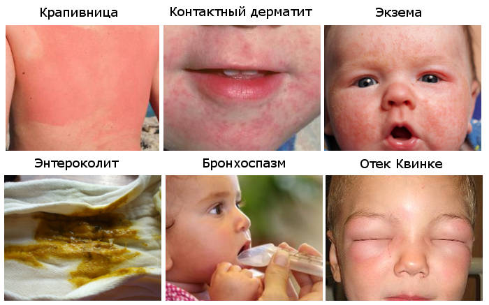 Фото - проявления пищевой аллергии у младенцев