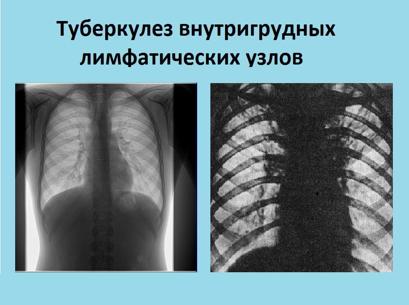 Туберкулез внутригрудных лимфоузлов