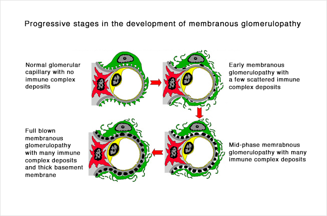 Membranous - progressive stages