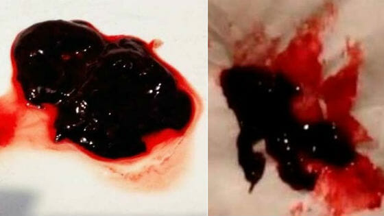 Сгустки крови при месячных фото