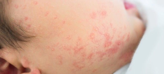 Как выглядит аллергический дерматит у детей раз