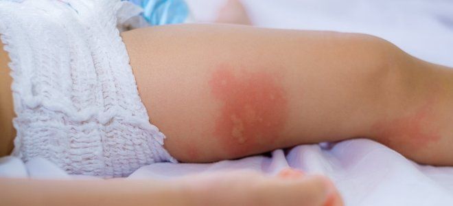 Как выглядит аллергический дерматит у детей три