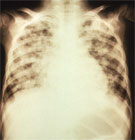 X-ray of Pneumonia caused by varicella.