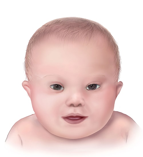 Illustration of child with Down syndrome