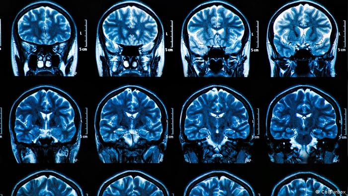 Снимки МРТ головного мозга человека